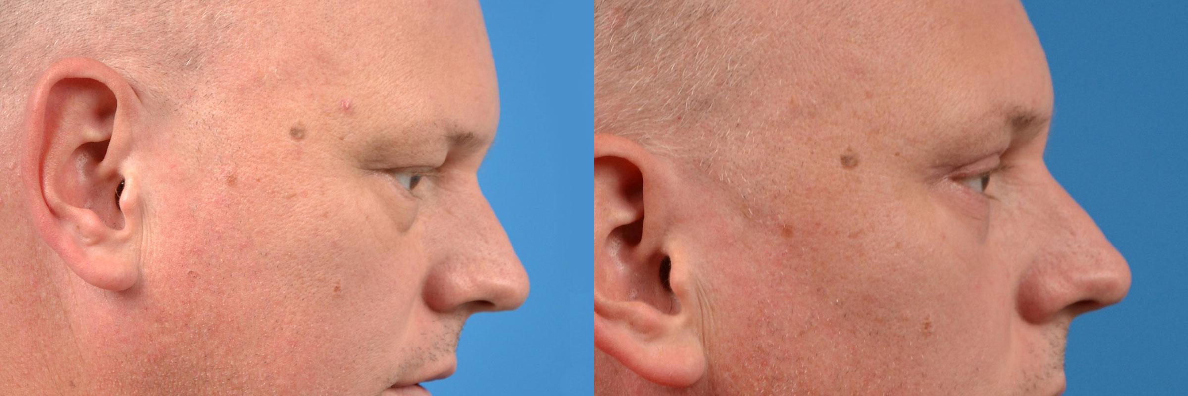 Eyelid Surgery Before & After Gallery - Patient 228965 - Image 3