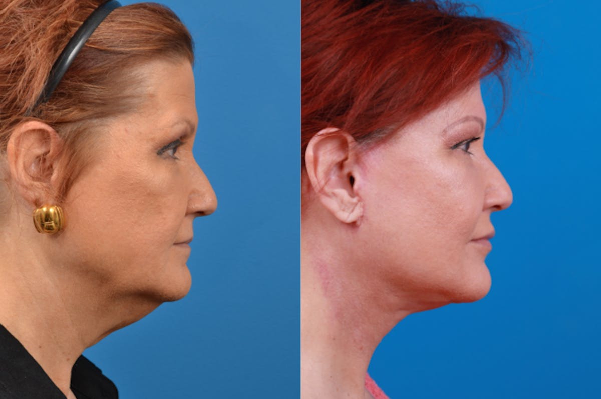 Facelift Before & After Gallery - Patient 122406153 - Image 5