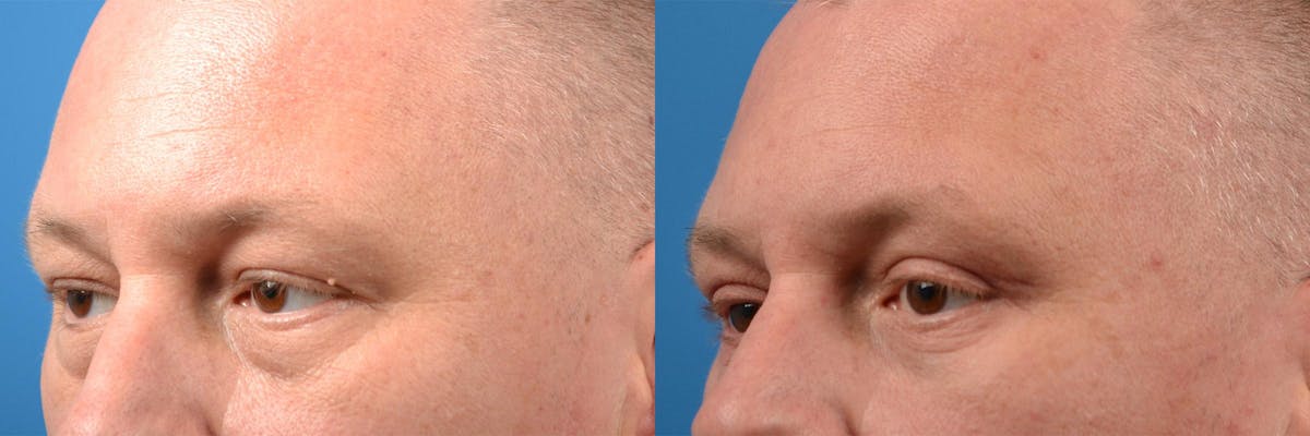 Eyelid Surgery Before & After Gallery - Patient 122406154 - Image 4
