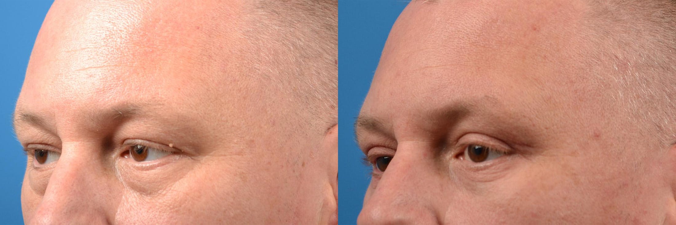 Eyelid Surgery Before & After Gallery - Patient 122406154 - Image 4