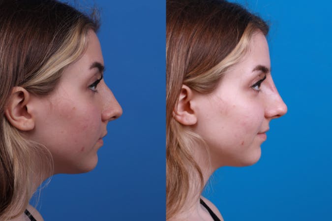 Liquid Rhinoplasty Before & After Gallery - Patient 122406157 - Image 1