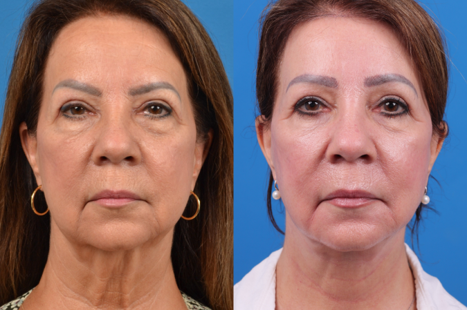 Facelift Before & After Gallery - Patient 122406158 - Image 1