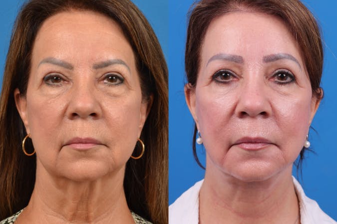 Facelift Before & After Gallery - Patient 122406158 - Image 1