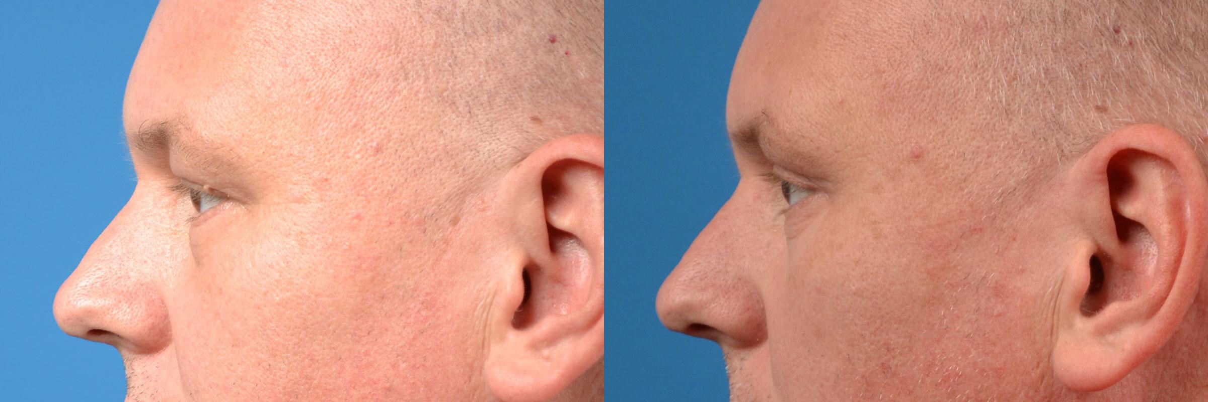 Eyelid Surgery Before & After Gallery - Patient 228965 - Image 5