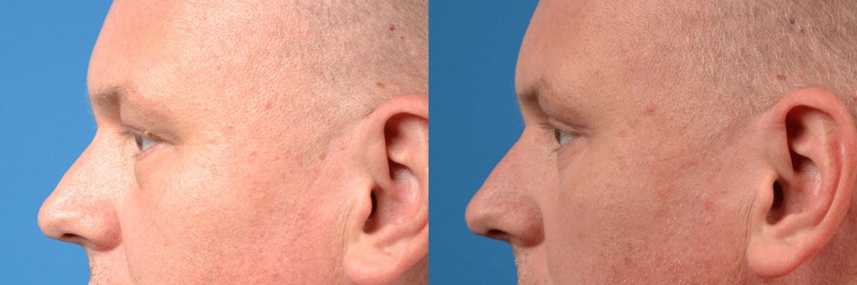 Eyelid Surgery Before & After Gallery - Patient 122406154 - Image 5