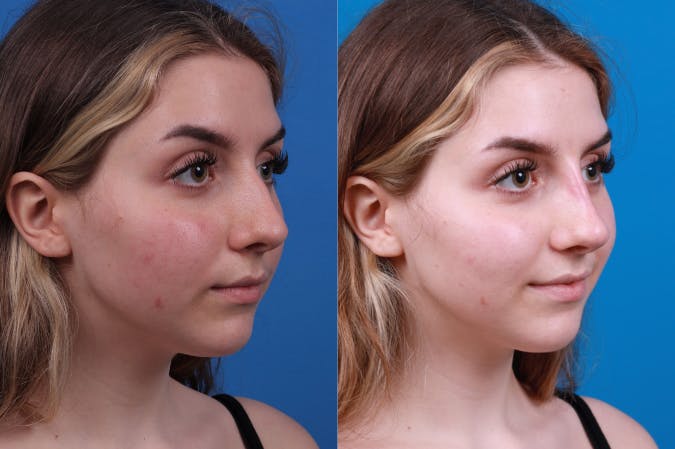 Liquid Rhinoplasty Before & After Gallery - Patient 122406157 - Image 2