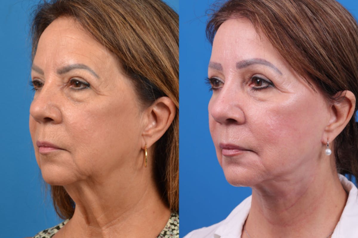 Facelift Before & After Gallery - Patient 122406158 - Image 2
