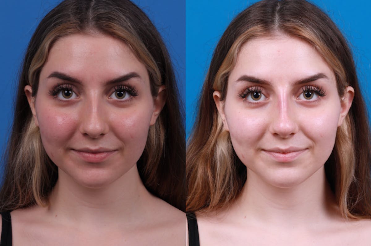 Liquid Rhinoplasty Before & After Gallery - Patient 122406157 - Image 3