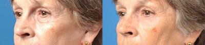 Eyelid Surgery Before & After Gallery - Patient 122406156 - Image 1