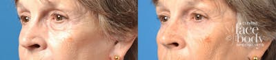 Eyelid Surgery Before & After Gallery - Patient 296723 - Image 1