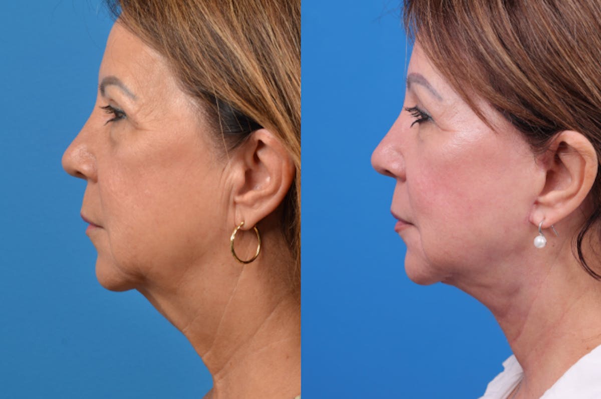 Facelift Before & After Gallery - Patient 122406158 - Image 3