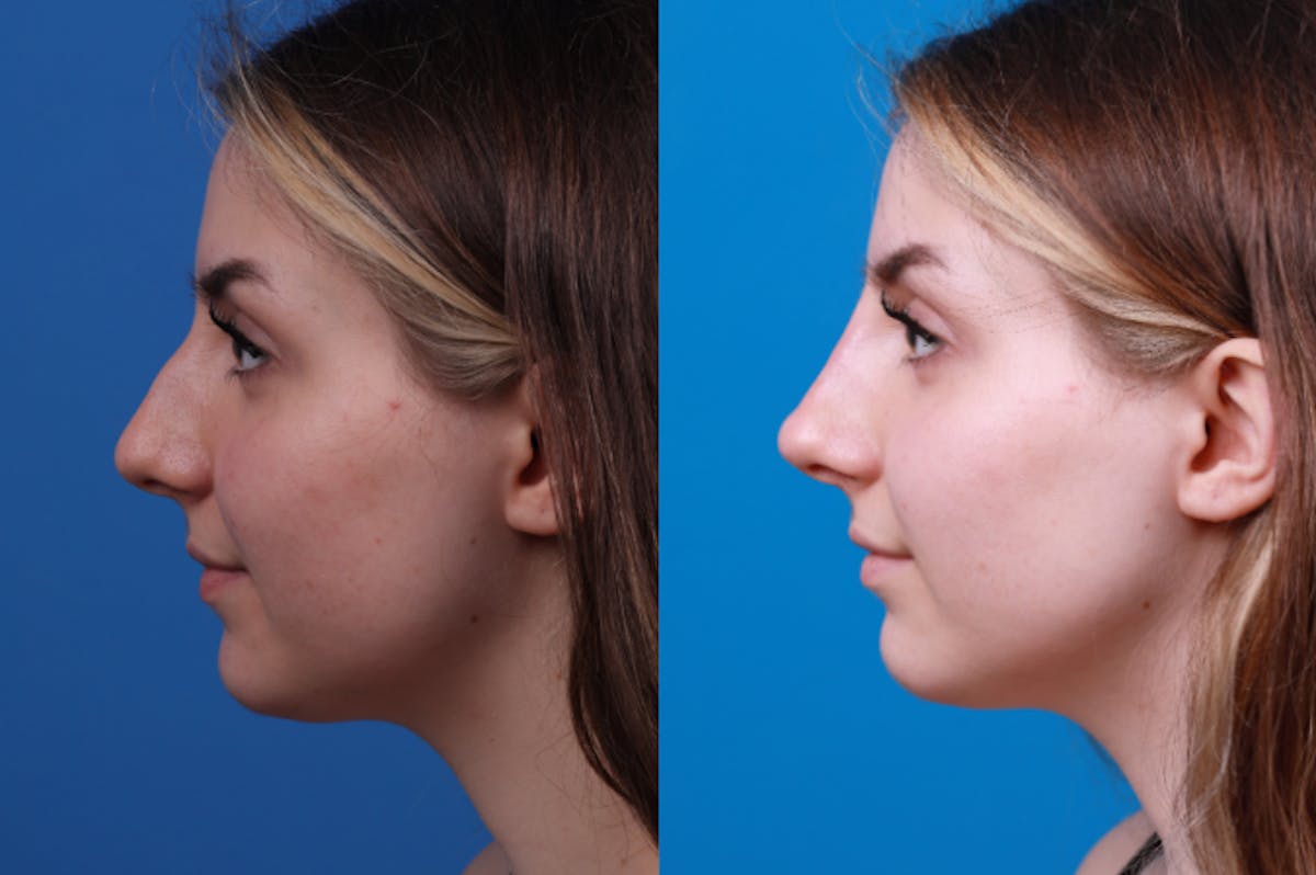 Liquid Rhinoplasty Before & After Gallery - Patient 122406157 - Image 4