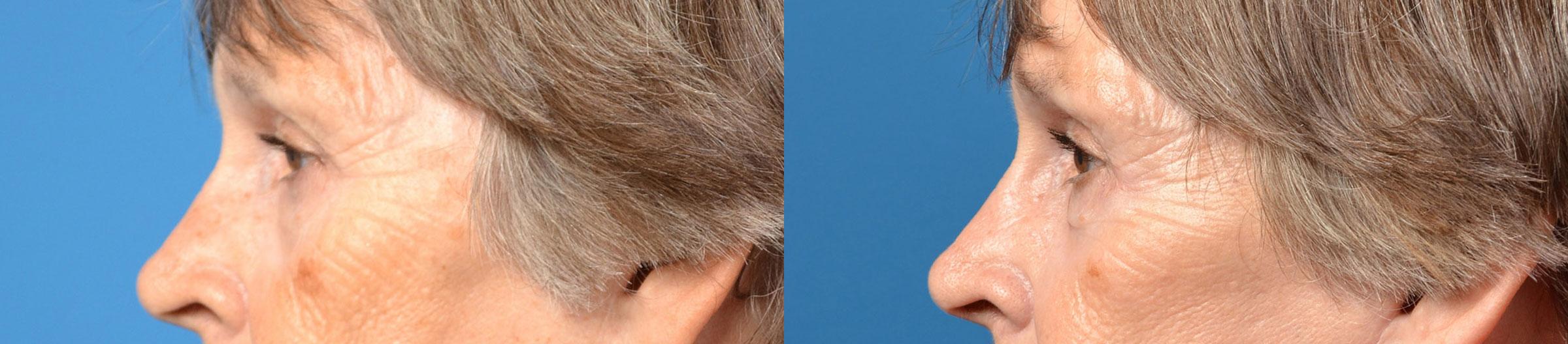 Eyelid Surgery Before & After Gallery - Patient 296723 - Image 2