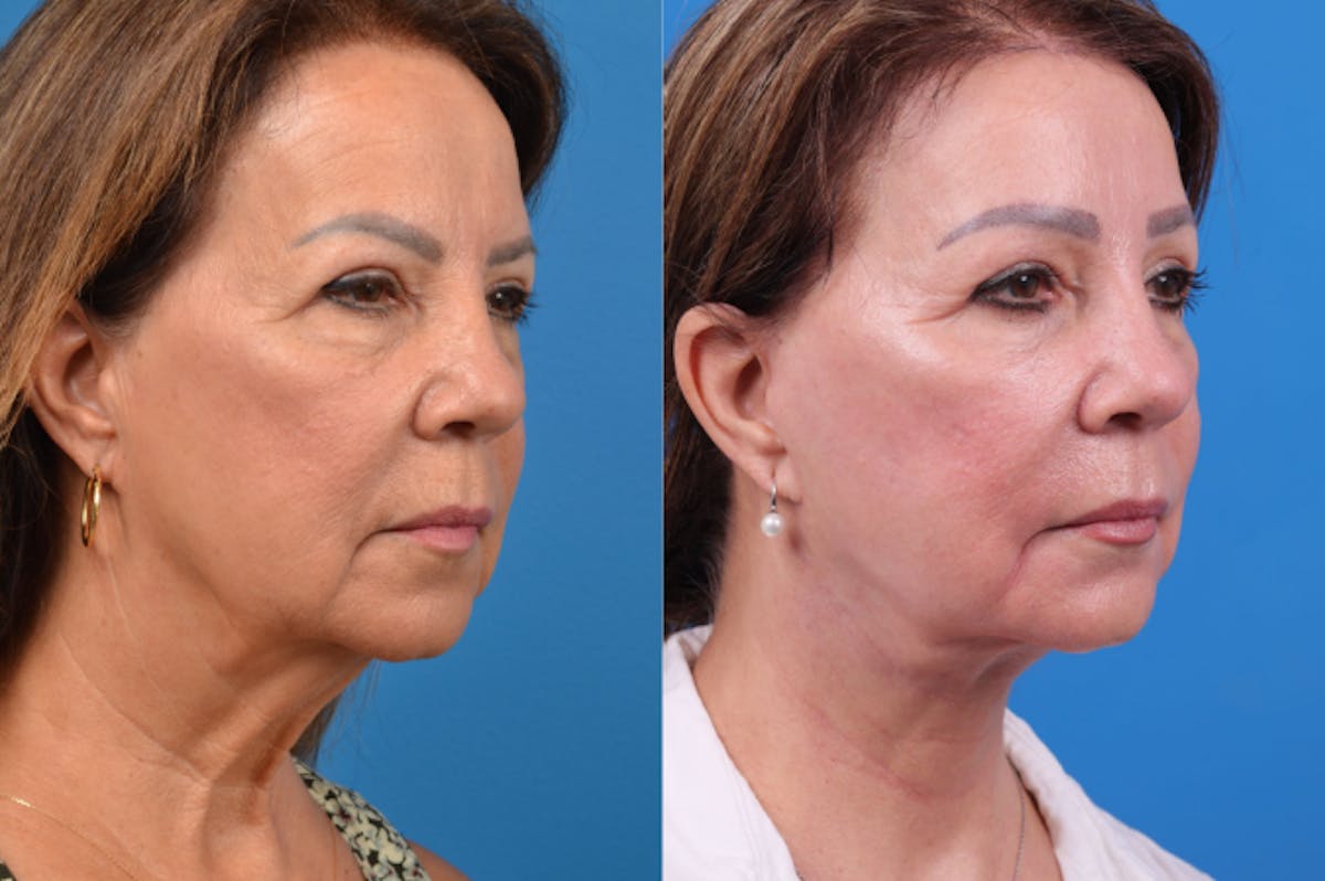 Facelift Before & After Gallery - Patient 122406158 - Image 4