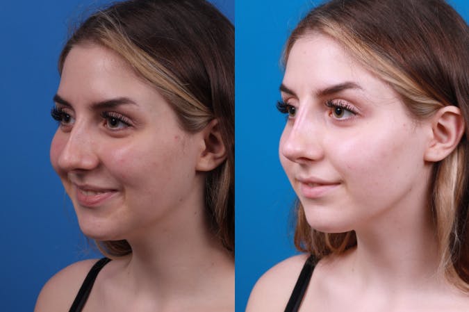 Liquid Rhinoplasty Before & After Gallery - Patient 122406157 - Image 5