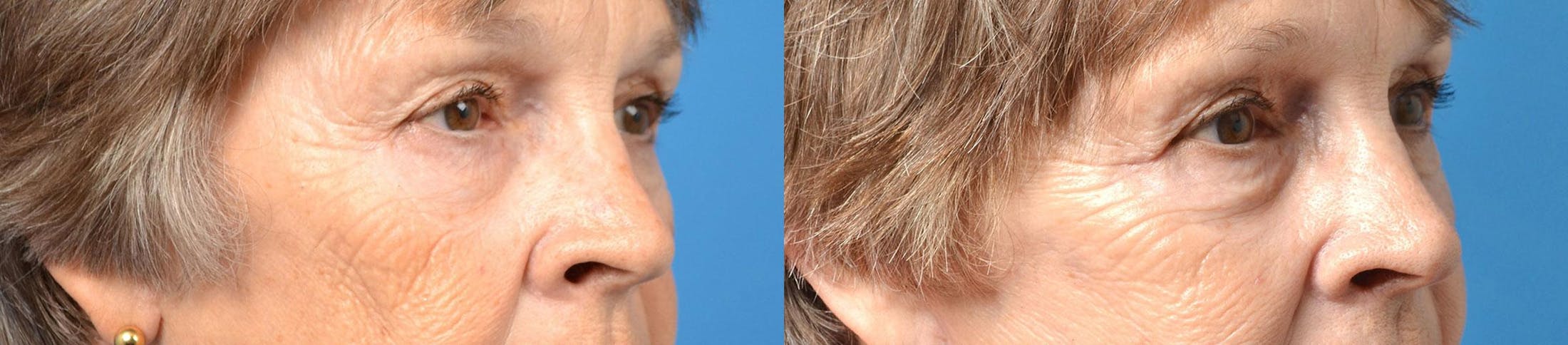 Eyelid Surgery Before & After Gallery - Patient 122406156 - Image 3