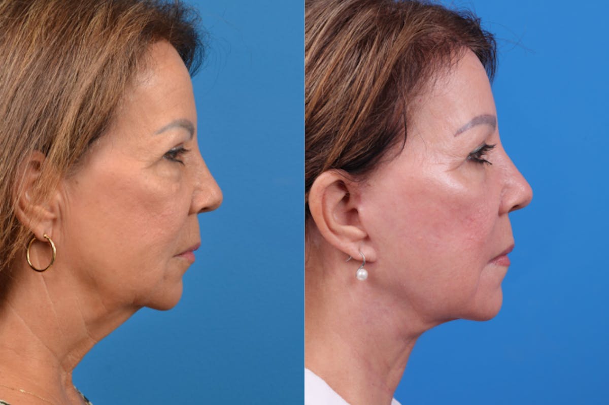 Facelift Before & After Gallery - Patient 122406158 - Image 5