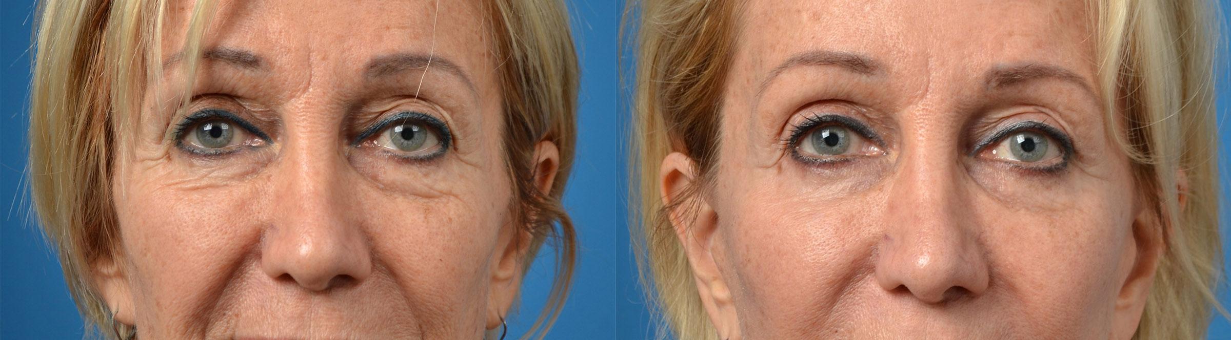 Eyelid Surgery Before & After Gallery - Patient 267525 - Image 1