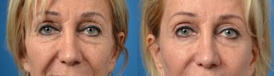 Eyelid Surgery Before & After Gallery - Patient 122406160 - Image 1