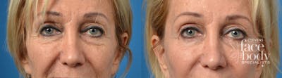 Eyelid Surgery Before & After Gallery - Patient 267525 - Image 1