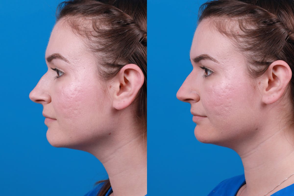 Liquid Rhinoplasty Before & After Gallery - Patient 122406163 - Image 1