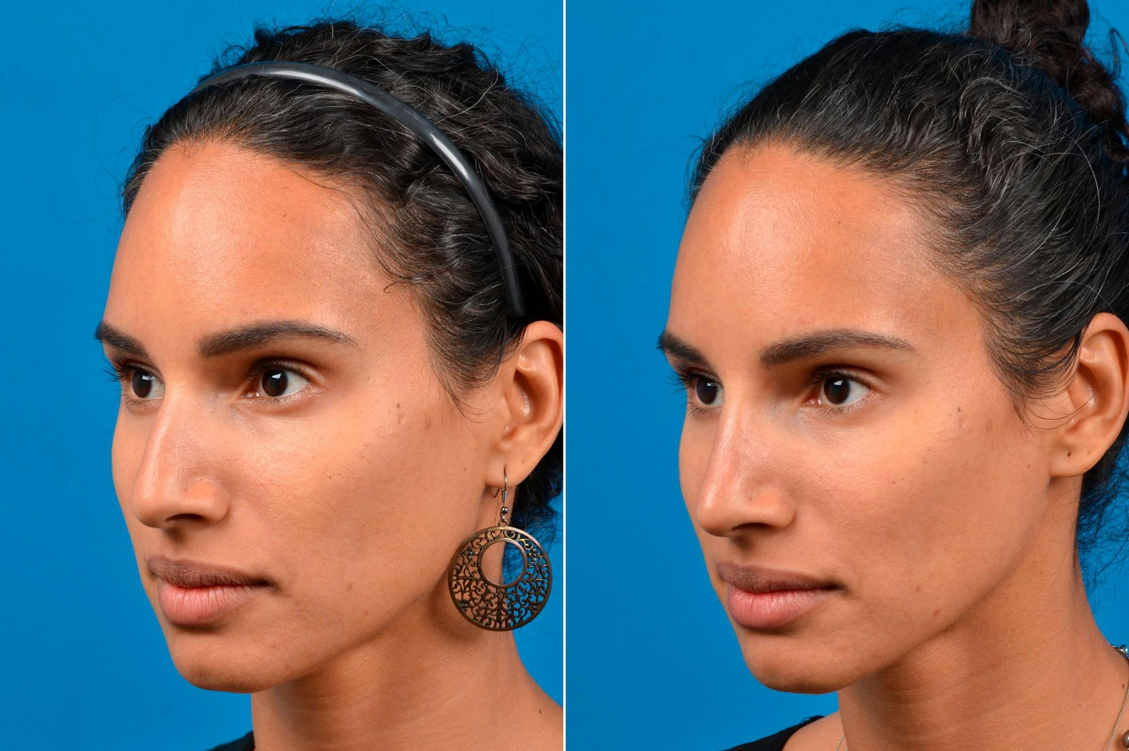 Liquid Rhinoplasty Before & After Gallery - Patient 122406159 - Image 4