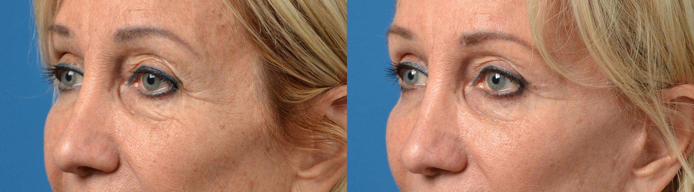 Eyelid Surgery Before & After Gallery - Patient 267525 - Image 2