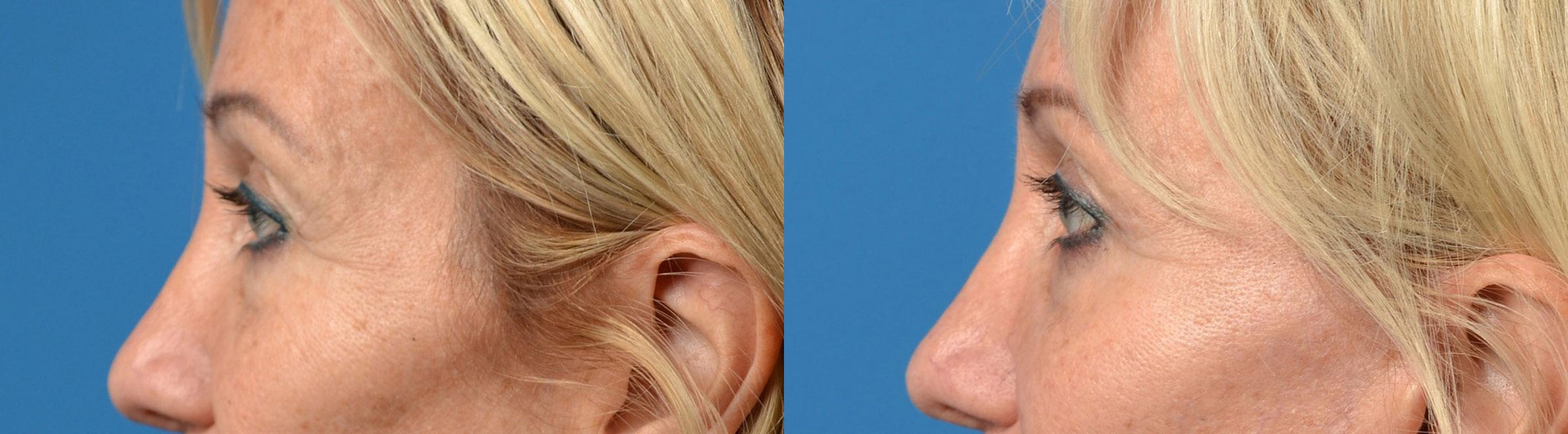 Eyelid Surgery Before & After Gallery - Patient 267525 - Image 3