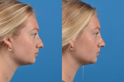 Liquid Rhinoplasty Before & After Gallery - Patient 122406162 - Image 1