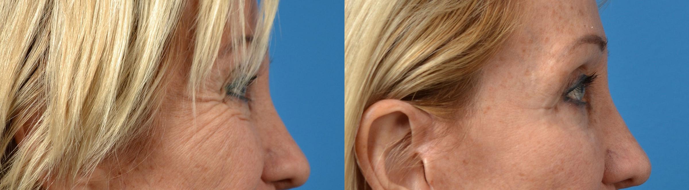 Eyelid Surgery Before & After Gallery - Patient 267525 - Image 4