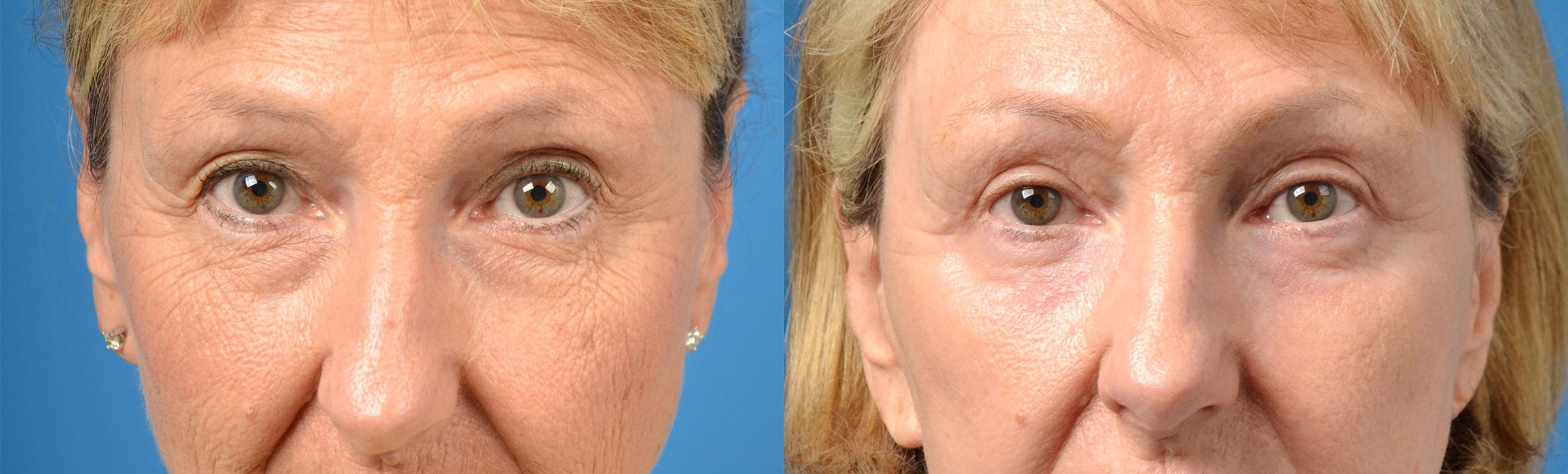 Eyelid Surgery Before & After Gallery - Patient 276940 - Image 1