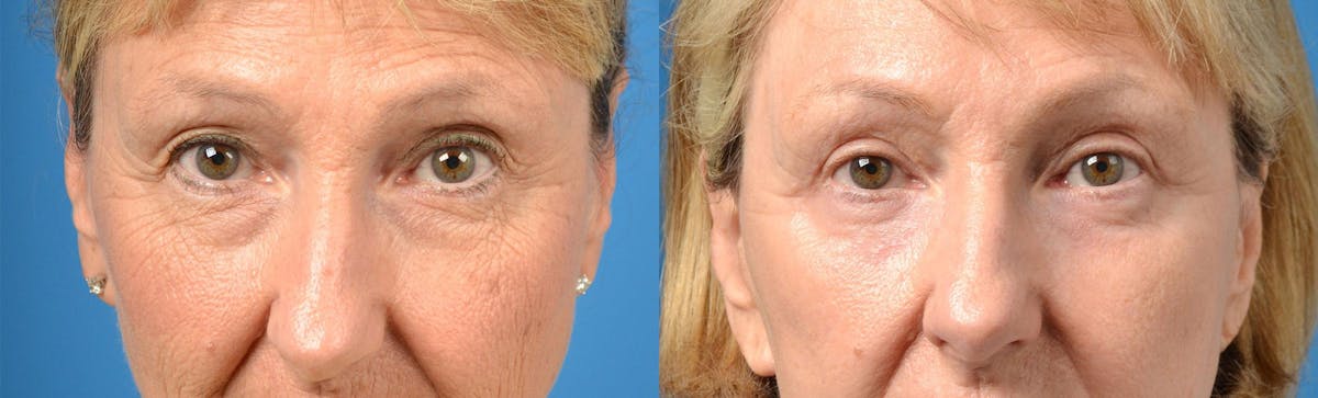 Eyelid Surgery Before & After Gallery - Patient 122406164 - Image 1