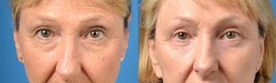 Eyelid Surgery Before & After Gallery - Patient 122406164 - Image 1
