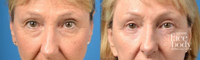 Eyelid Surgery Before & After Gallery - Patient 276940 - Image 1