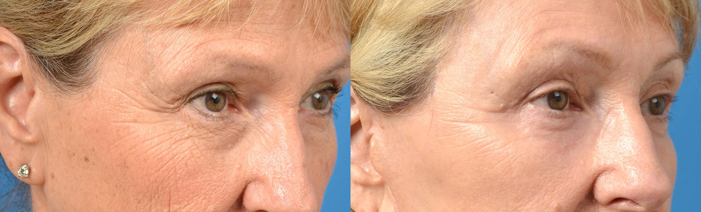 Eyelid Surgery Before & After Gallery - Patient 276940 - Image 2