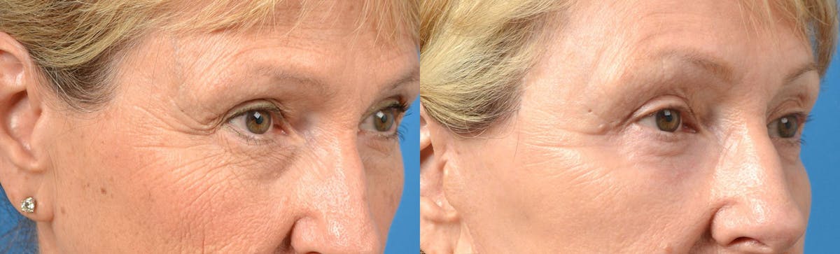Eyelid Surgery Before & After Gallery - Patient 122406164 - Image 2