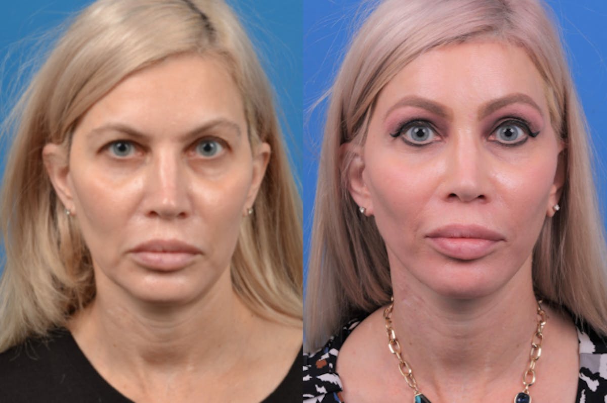Facelift Before & After Gallery - Patient 122406166 - Image 1