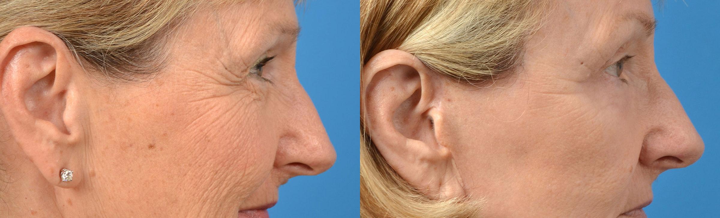 Eyelid Surgery Before & After Gallery - Patient 276940 - Image 3