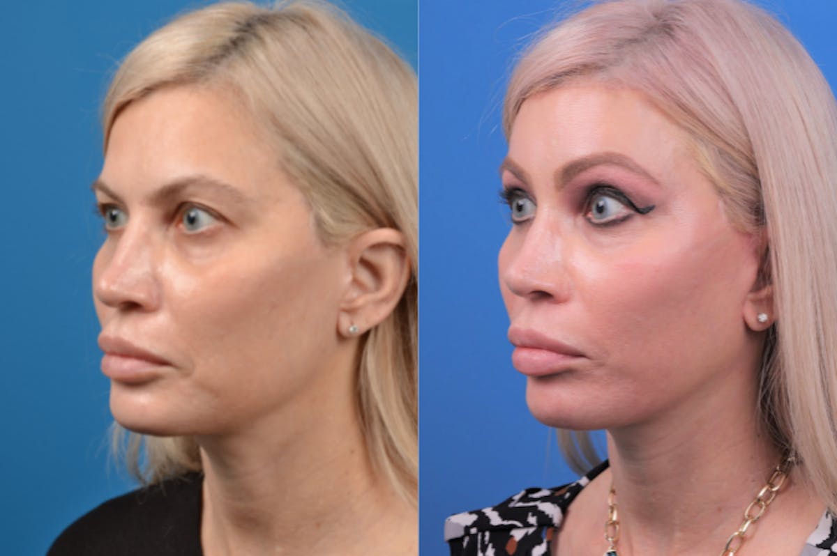 Facelift Before & After Gallery - Patient 122406166 - Image 2