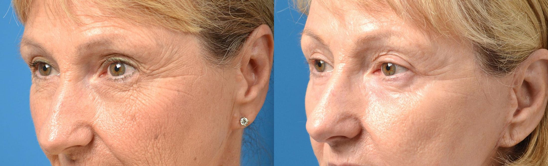 Eyelid Surgery Before & After Gallery - Patient 122406164 - Image 4