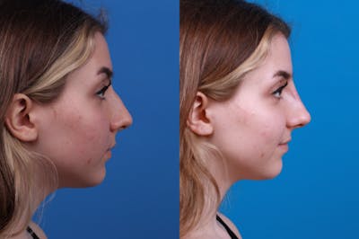 Liquid Rhinoplasty Before & After Gallery - Patient 122406168 - Image 1