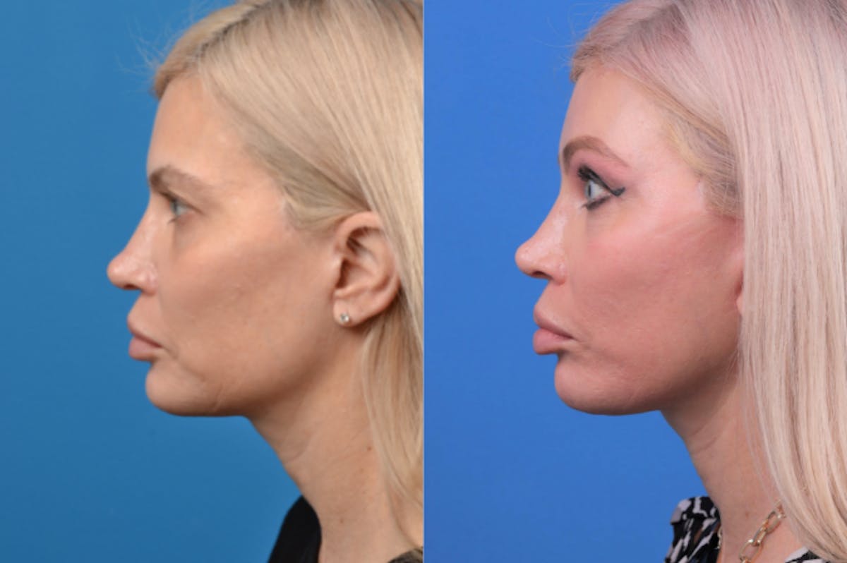 Facelift Before & After Gallery - Patient 122406166 - Image 3