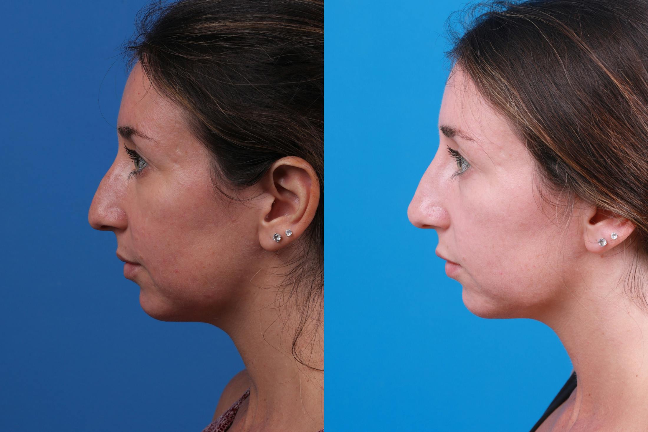Liquid Rhinoplasty Before & After Gallery - Patient 122406169 - Image 1