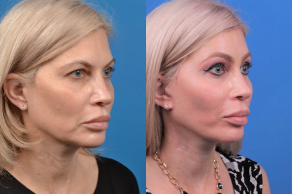 Facelift Before & After Gallery - Patient 122406166 - Image 4