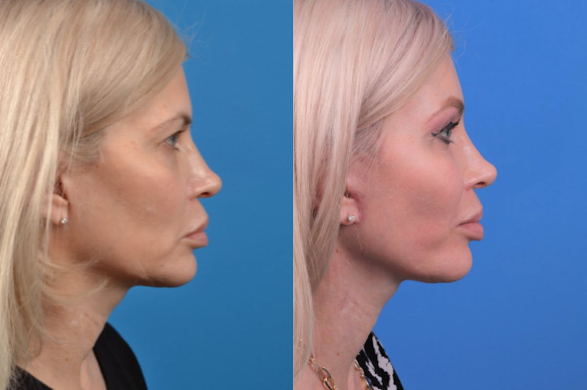 Facelift Before & After Gallery - Patient 122406166 - Image 5