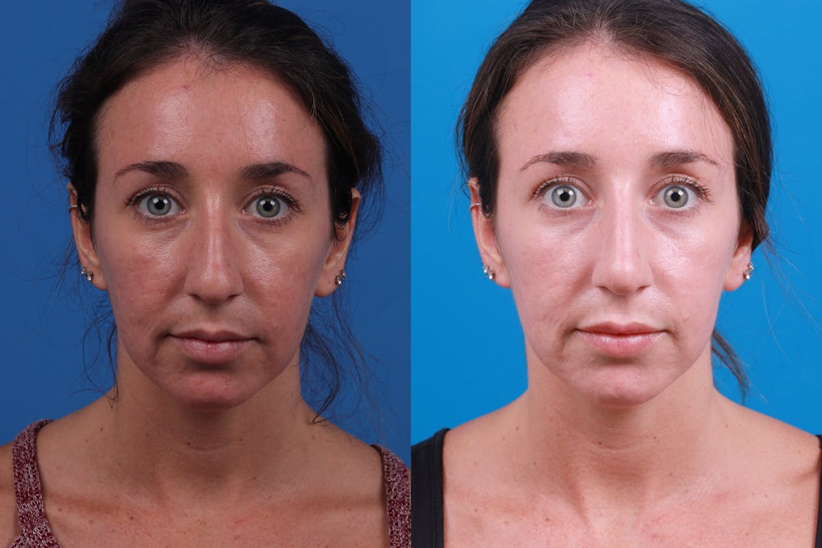 Liquid Rhinoplasty Before & After Gallery - Patient 122406169 - Image 2