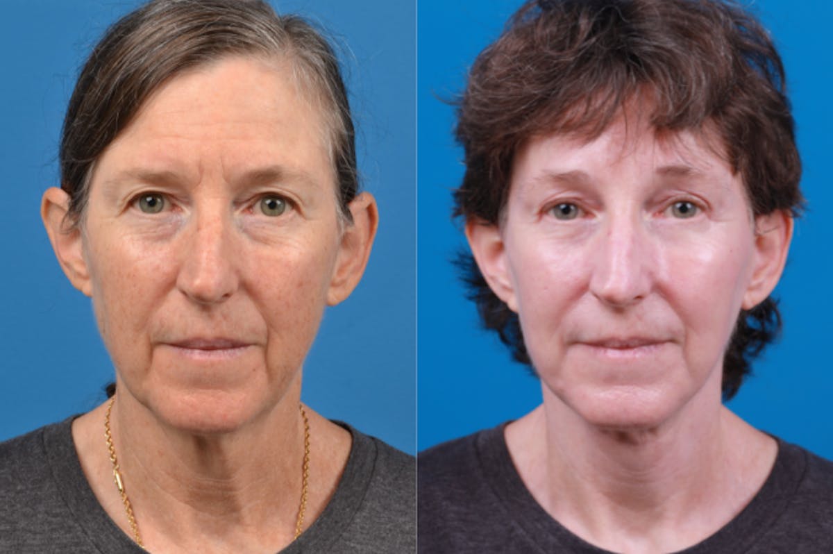 Facelift Before & After Gallery - Patient 122406170 - Image 1