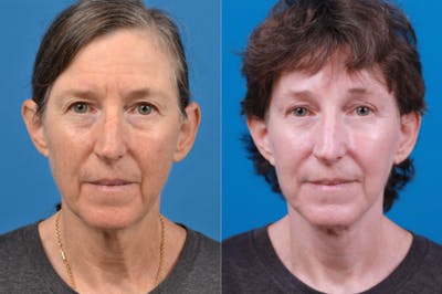 Facelift Before & After Gallery - Patient 122406170 - Image 1