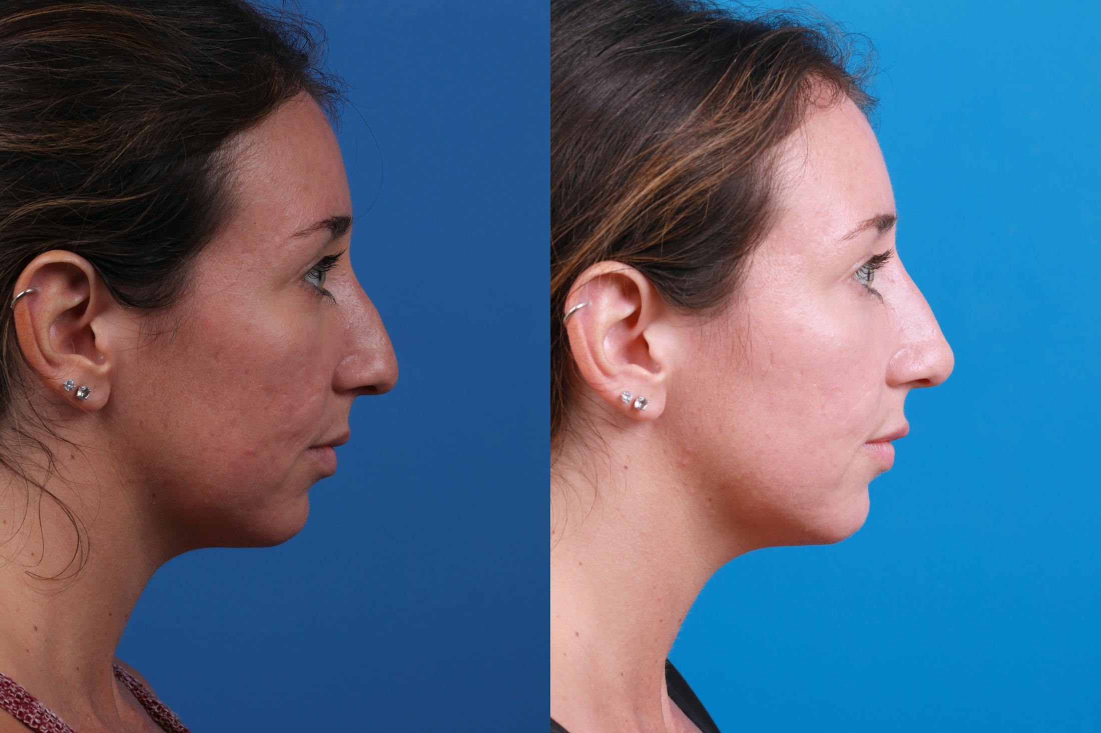 Liquid Rhinoplasty Before & After Gallery - Patient 122406169 - Image 3