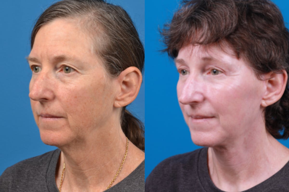 Facelift Before & After Gallery - Patient 122406170 - Image 2